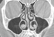 Porción nasal interna