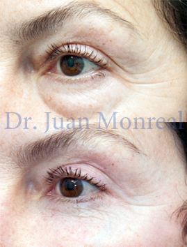 Cirugía estética en el contorno de ojos. Dr. Juan Monreal