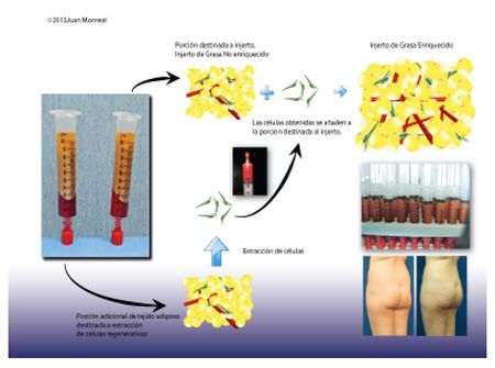 Lipoimplante enriquecido con células regenerativas - Dr. Juan Monreal