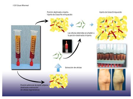 Que es un lipoimplante enriquecido con células regenerativas