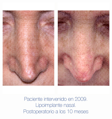 Antes y después - Preoperatorio - Postoperatorio - Rinomodelación con lipoimplante nasal - Dr. Juan Monreal