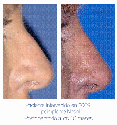 Antes y después - Preoperatorio - Postoperatorio - Rinomodelación con lipoimplante nasal - Dr. Juan Monreal