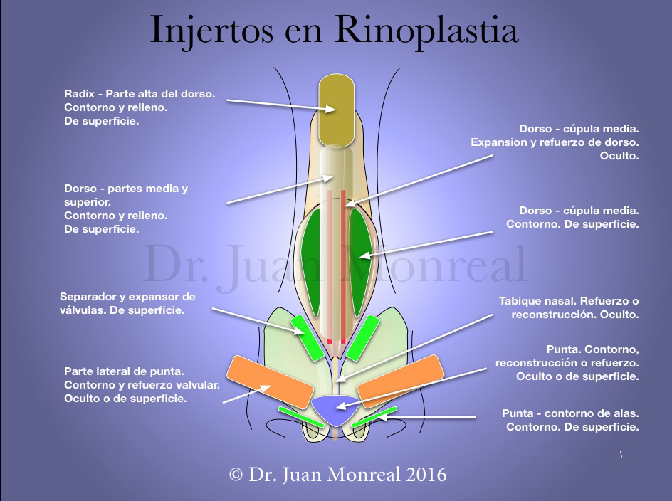 rinoplastia-esquema-injertos-dr-monreal-f