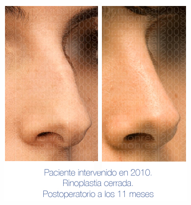 Antes y después - Preoperatorio - Postoperatorio de Rinoplastia - Rinoseptoplastia cerrada - Dr. Juan Monreal