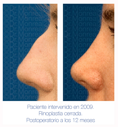 Antes y después - Preoperatorio - Postoperatorio de Rinoplastia - Rinoseptoplastia cerrada - Dr. Juan Monreal