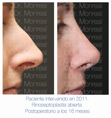 Antes y después - Preoperatorio - Postoperatorio de Rinoplastia - Rinoseptoplastia abierta - Dr. Juan Monreal