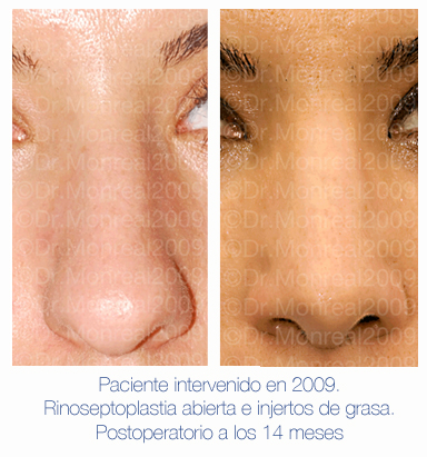 Antes y después - Preoperatorio - Postoperatorio de Rinoplastia - Rinoseptoplastia abierta e injertos de grasa - Dr. Juan Monreal