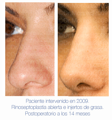 Antes y después - Preoperatorio - Postoperatorio de Rinoplastia - Rinoseptoplastia abierta e injertos de grasa - Dr. Juan Monreal