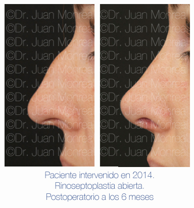Antes y después - Preoperatorio - Postoperatorio de Rinoplastia - Rinoseptoplastia abierta - Dr. Juan Monreal