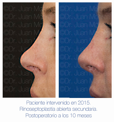 Antes y después - Preoperatorio - Postoperatorio de Rinoplastia - Rinoseptoplastia abierta secundaria - Dr. Juan Monreal