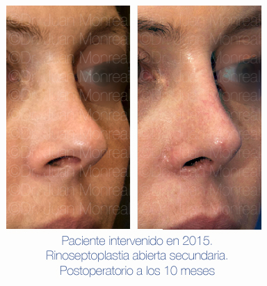 Antes y después - Preoperatorio - Postoperatorio de Rinoplastia - Rinoseptoplastia abierta secundaria - Dr. Juan Monreal