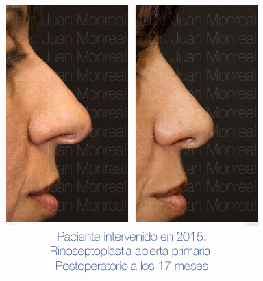 Antes y después - Preoperatorio - Postoperatorio de Rinoplastia - Rinoseptoplastia abierta - Dr. Juan Monreal