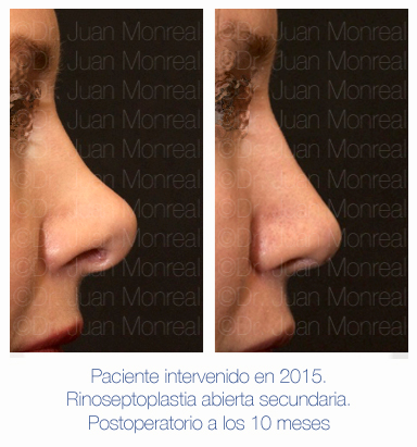 Antes y después - Preoperatorio - Postoperatorio de Rinoplastia - Rinoseptoplastia abierta - Dr. Juan Monreal