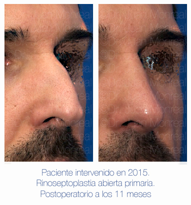 Antes y después - Preoperatorio - Postoperatorio de Rinoplastia - Rinoseptoplastia abierta - Dr. Juan Monreal