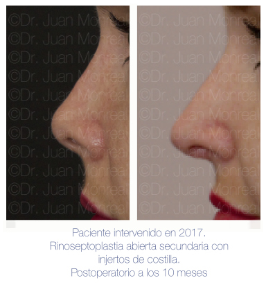 Antes y después - Preoperatorio - Postoperatorio de Rinoplastia - Rinoseptoplastia abierta - Dr. Juan Monreal