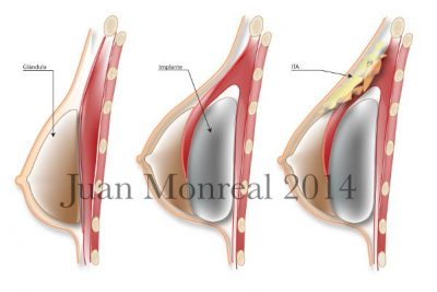 Tratamiento Aumento mamario compuesto Mastopexia Compuesta Dr. Juan Monreal