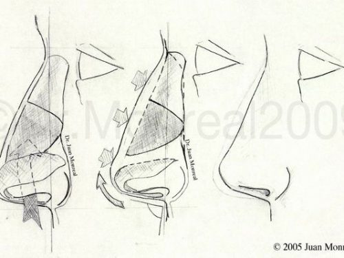 Tratamiento Rinoplastia Dr. Juan Monreal