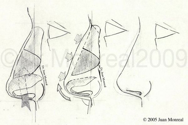 Tratamiento Rinoplastia Dr. Juan Monreal