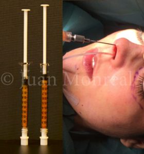 lipofilling nariz Dr Juan Monreal