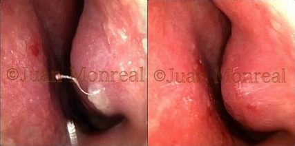 tratamiento síndrome nariz vacía - dr monreal
