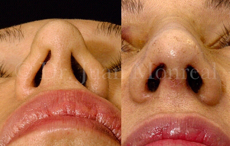 tratamiento-válvulas-nasales-dr-juan-monreal