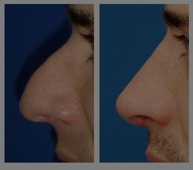 Antes y después - Preoperatorio - Postoperatorio de Rinoplastia. Dr. Juan Monreal