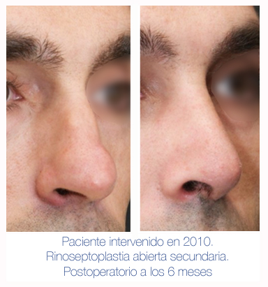 Antes y después - Preoperatorio - Postoperatorio de Rinoplastia - Rinoseptoplastia abierta secundaria - Dr. Juan Monreal