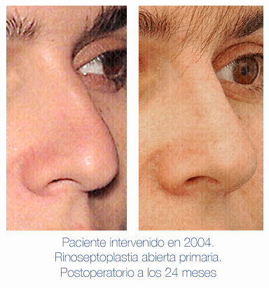 Antes y después - Preoperatorio - Postoperatorio de Rinoplastia - Rinoseptoplastia abierta primaria - Dr. Juan Monreal