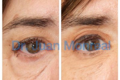 Tratamiento Cirugia Estética Contorno Ojos Dr. Juan Monreal
