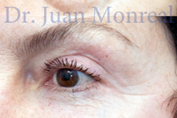 Tratamiento Cirugia Estética Contorno Ojos Dr. Juan Monreal