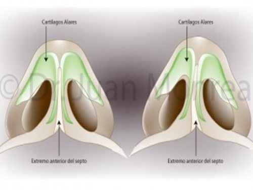 Tratamiento Rinoseptoplastia Dr. Juan Monreal