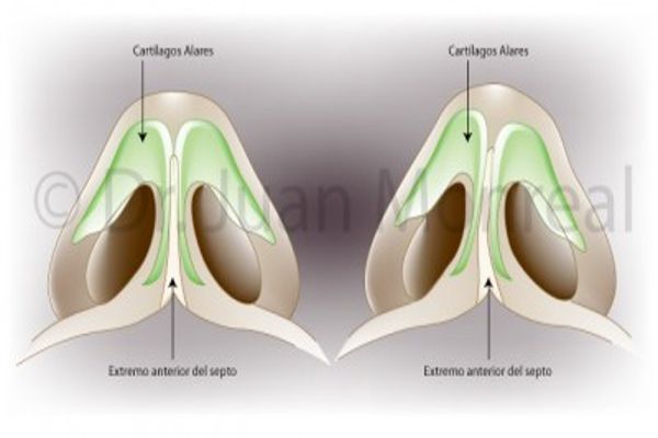 Tratamiento Rinoseptoplastia Dr. Juan Monreal