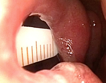 nariz-perforacion-de-tabique-nasal-dr-monreal