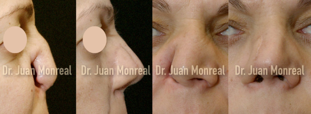 reconstrucción nasal dr juan monreal