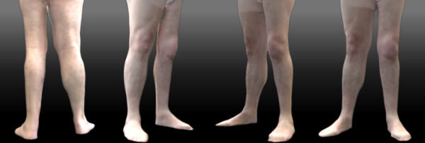 Asimetría de piernas