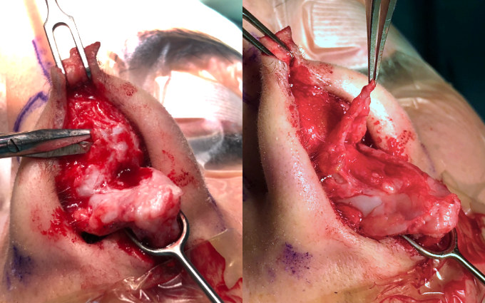 Antes después fibrosis de nariz. Dr. Juan Monreal