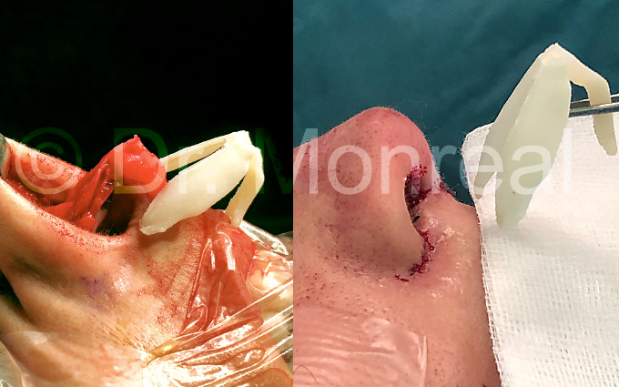 Antes después fibrosis de nariz. Dr. Juan Monreal