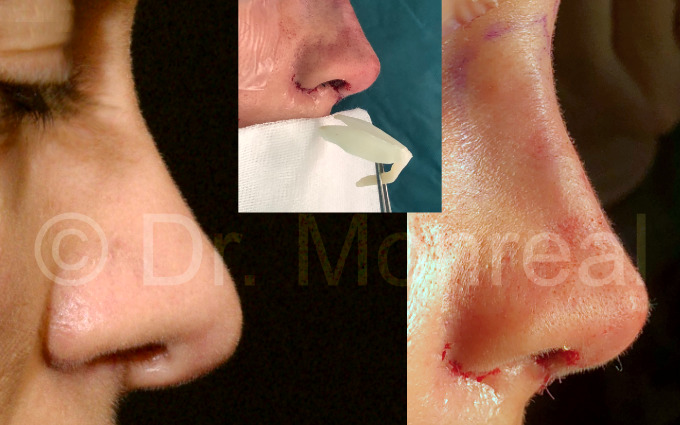 Antes después fibrosis de nariz. Dr. Juan Monreal