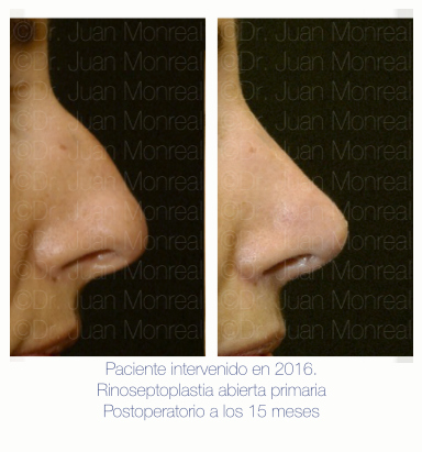 Antes Después de Rinoplastia. Dr. Juan Monreal