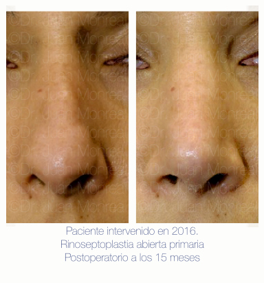 Antes Después de Rinoplastia. Dr. Juan Monreal