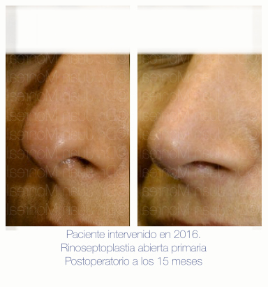 Antes Después de Rinoplastia. Dr. Juan Monreal