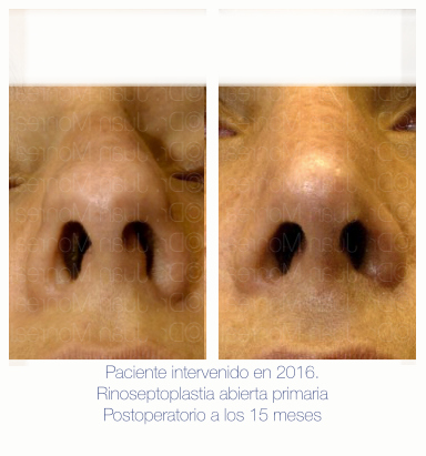 Antes Después de Rinoplastia. Dr. Juan Monreal