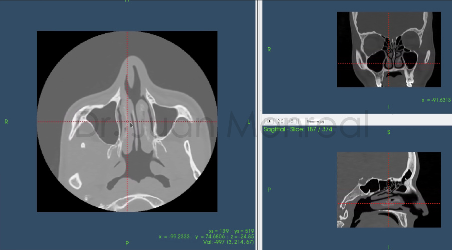 Cirugía Virtual - Obstrucción de nariz