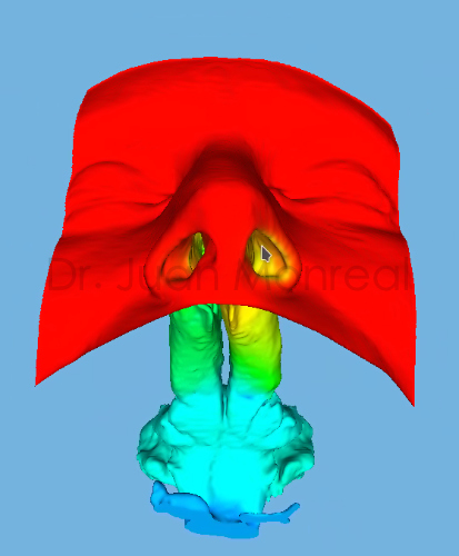 Virtual Surgery for Patients with Nasal Obstruction