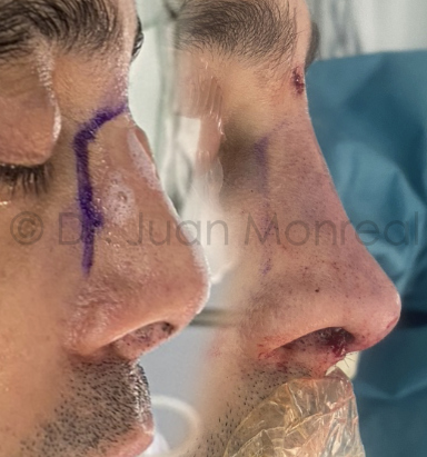 Antes Después de Rinoplastia secundaria realizada con injertos de costilla Dr Juan Monreal