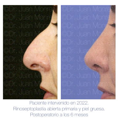 Antes Después Rinoplastia primaria - Dr Juan Monreal