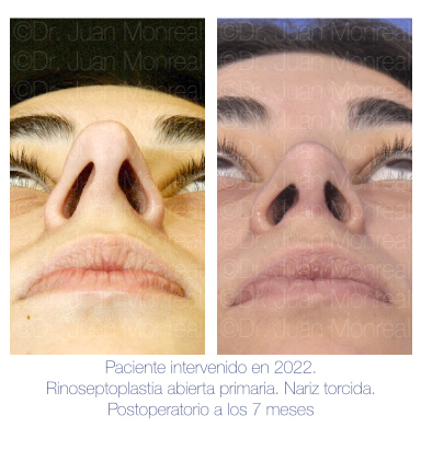 Antes y Después de Rinoplastia primaria, nariz torcida y piel fina - Dr Juan Monreal