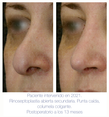 Antes y Después de Rinoplastia secundaria - Dr Juan Monreal