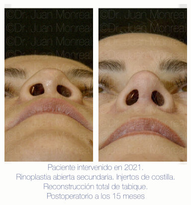Antes y Después de Rinoplastia secundaria con injertos de costilla - Dr Juan Monreal