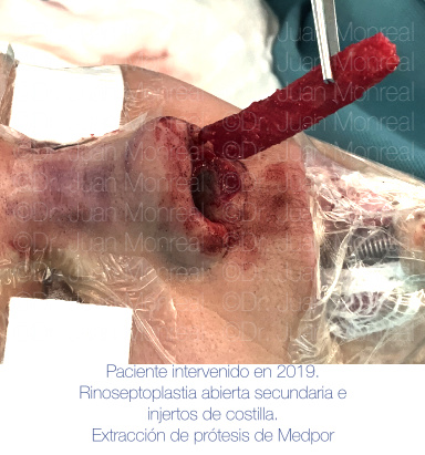 Intraoperatorio extracción de prótesis nasal Medpor